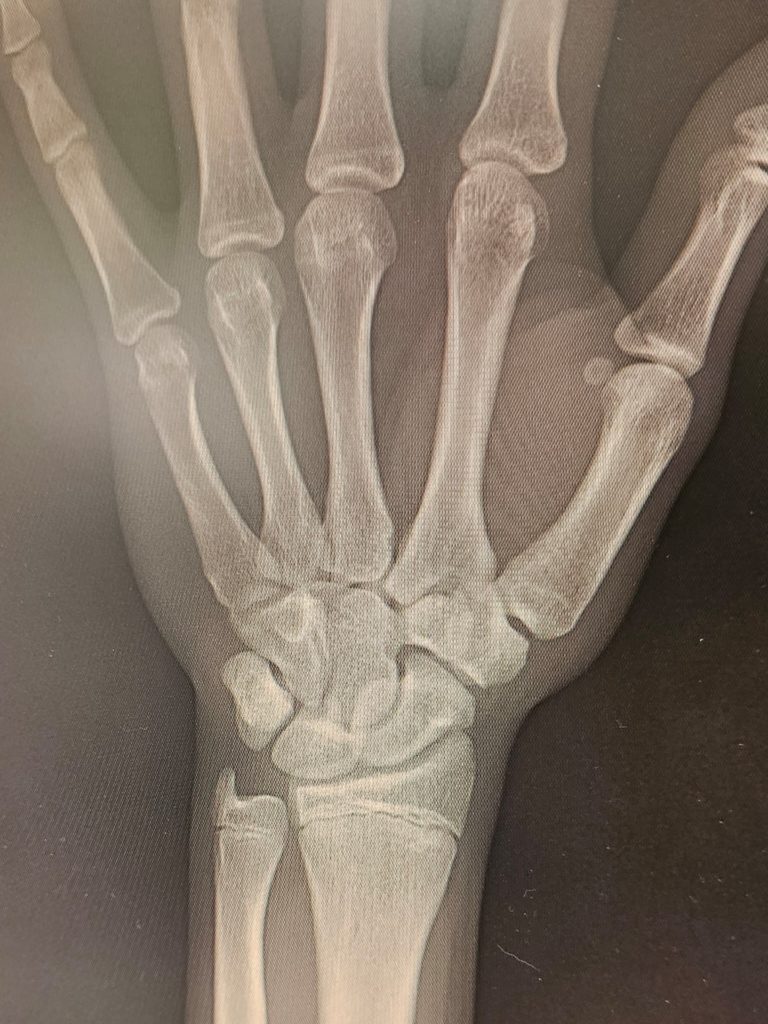 骨端線を知ろう！身長を伸ばしたい子どもに役立つQ&A 30選